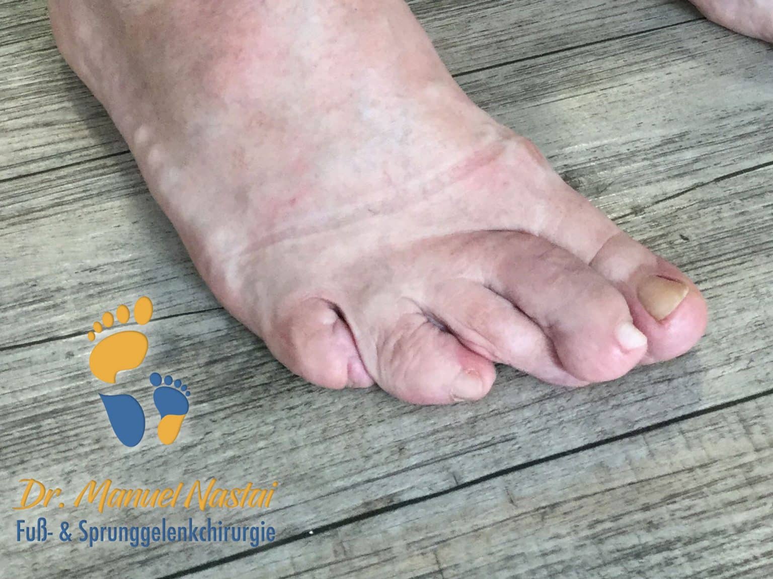 Curly toe (Lockenzehe) - Dr.-medic Manuel Nastai | Fußchirurgie