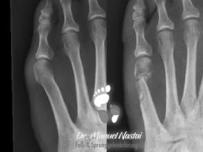 Minimalinvasive chevronette bei Digitus quintus varus Typ I