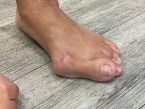 Hallux valgus seitlicher Ansicht