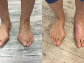 Hallux valgus vorher - nachher
