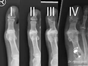 Hallux rigidus Stadien auf der dorsoplantaren Aufnahme