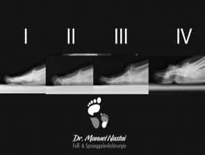 Hallux rigidus Stadien auf der seitlichen Aufnahme