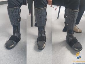 Rahmenorthese bei Charcot-Fuß