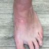 Arthrose der Mittelfußgelenke Arthrose der Mittelfußgelenke