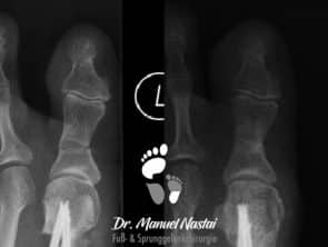 Ausheilungsbild nach Akin-Osteotomie ohne Osteosynthese