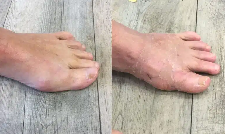 Minimalinvasive Hallux valgus Operation