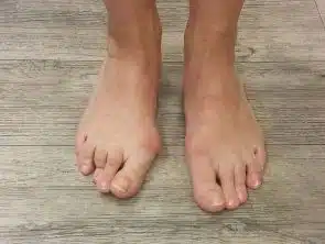 Foto mit einem einseitigen Hallux valgus