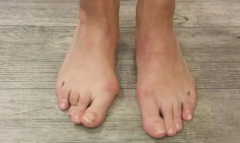 Foto mit einem einseitigen Hallux valgus