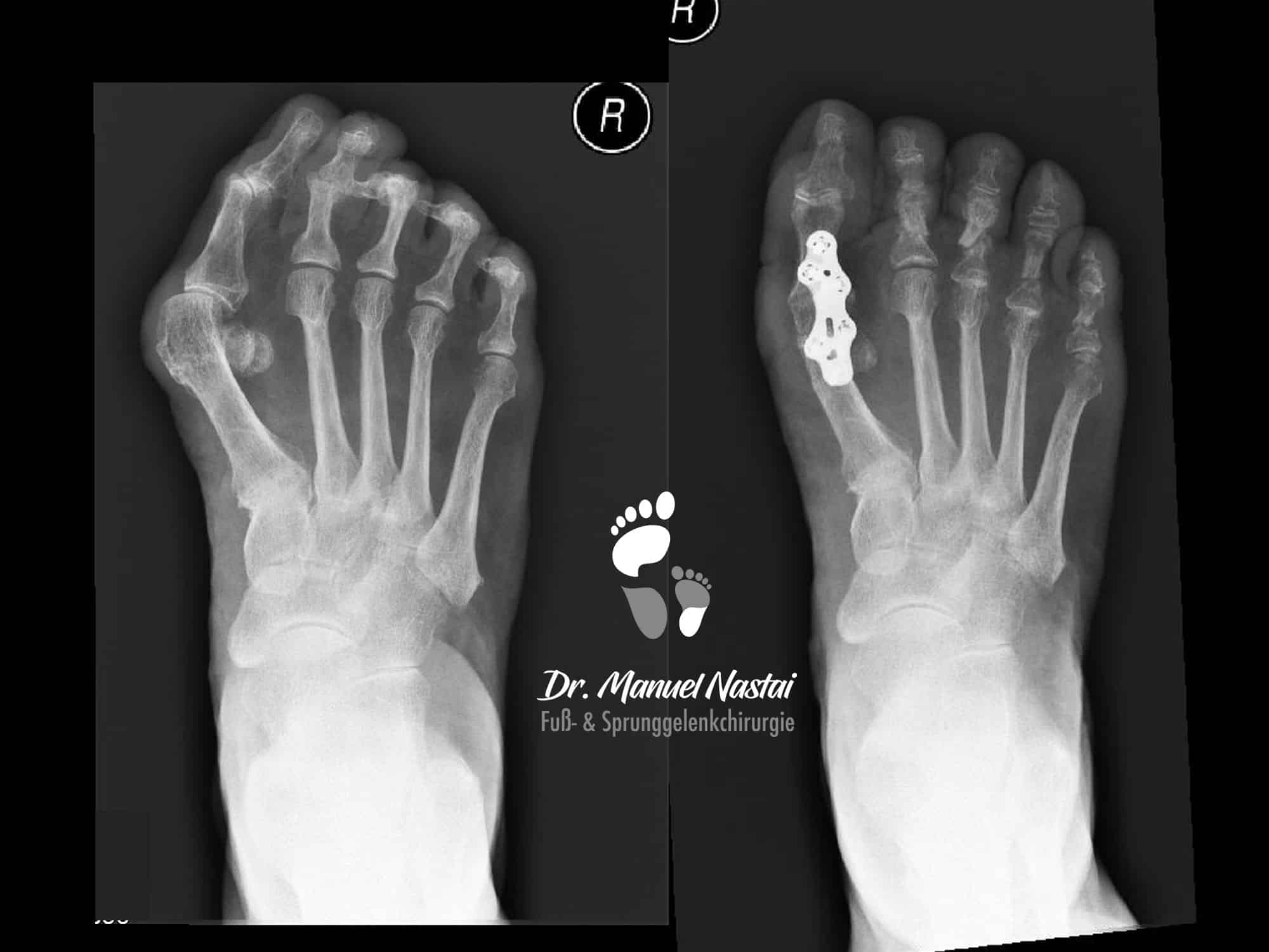 Hallux valgus, Ballenzeh - was ist und wie wird behandelt