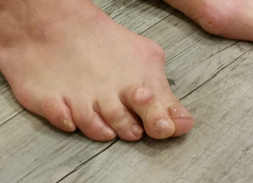 Hallux valgus, Ballenzeh was ist und wie wird behandelt