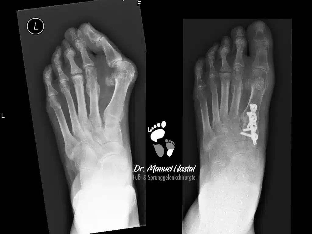 Lapidus Arthrodese bei Hallux valgus