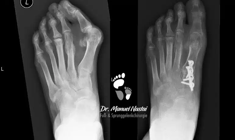 Lapidus Arthrodese bei Hallux valgus