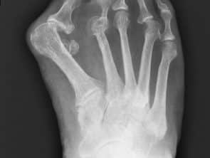 Röntgenbild Hallux valgus