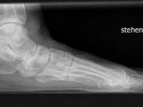 Röntgenbild Hallux valgus seitlich