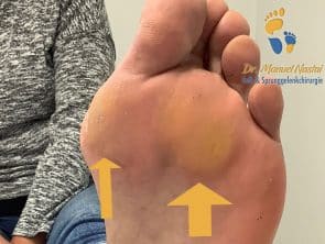 Schwielen bei Hallux valgus