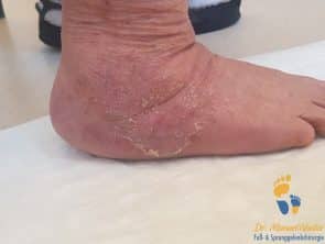 Narbe nach minimalinvasiver Exostosenresektion bei Charcot-Fuß