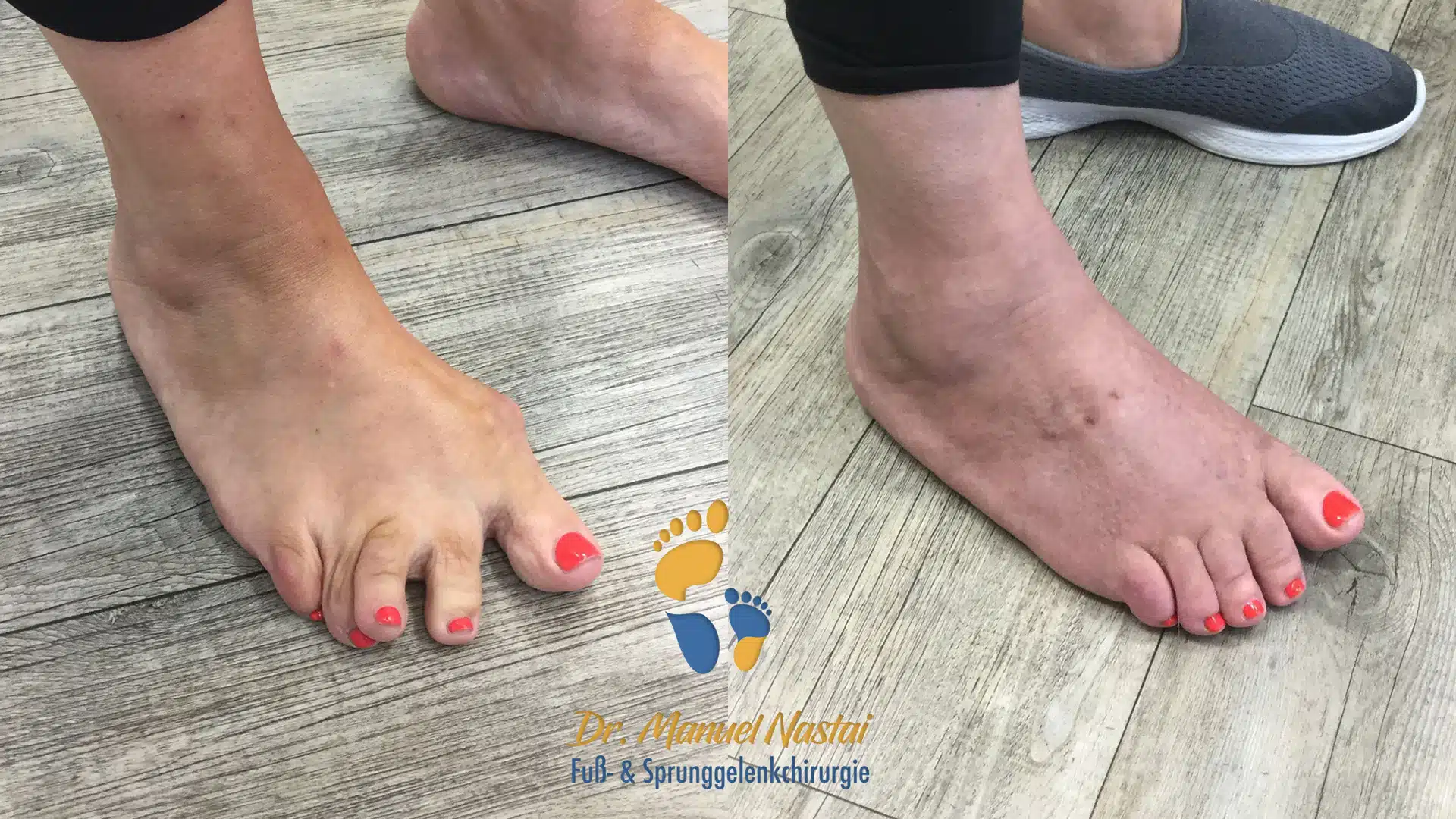 Minimalinvasive Korrektur Hallux valgus et Metatarsus adductus