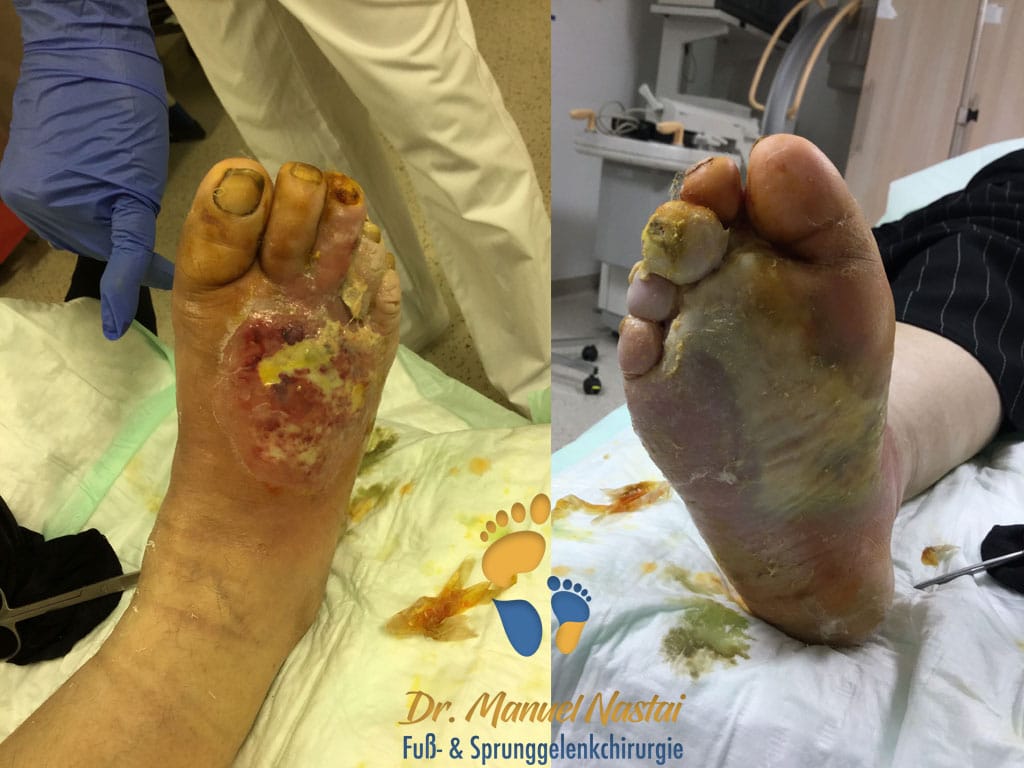 Infizierte Gangrän bei diabetischem Fuß