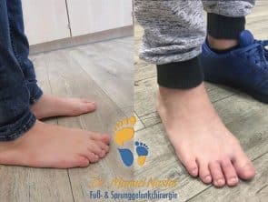Ergebnis nach Trennung cutaner Syndaktylie