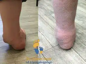 Chronische Außenbandinstabilität