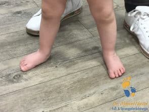 Ergebnis nach erfolgreicher Ponseti-Behandlung bei idiopathischem Klumpfuß