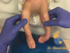 Baby mit idiopathischem Klumpfuß - Bild von vorne