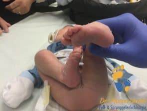 Baby mit idiopathischem Klumpfuß - Bild von der Fußsohle