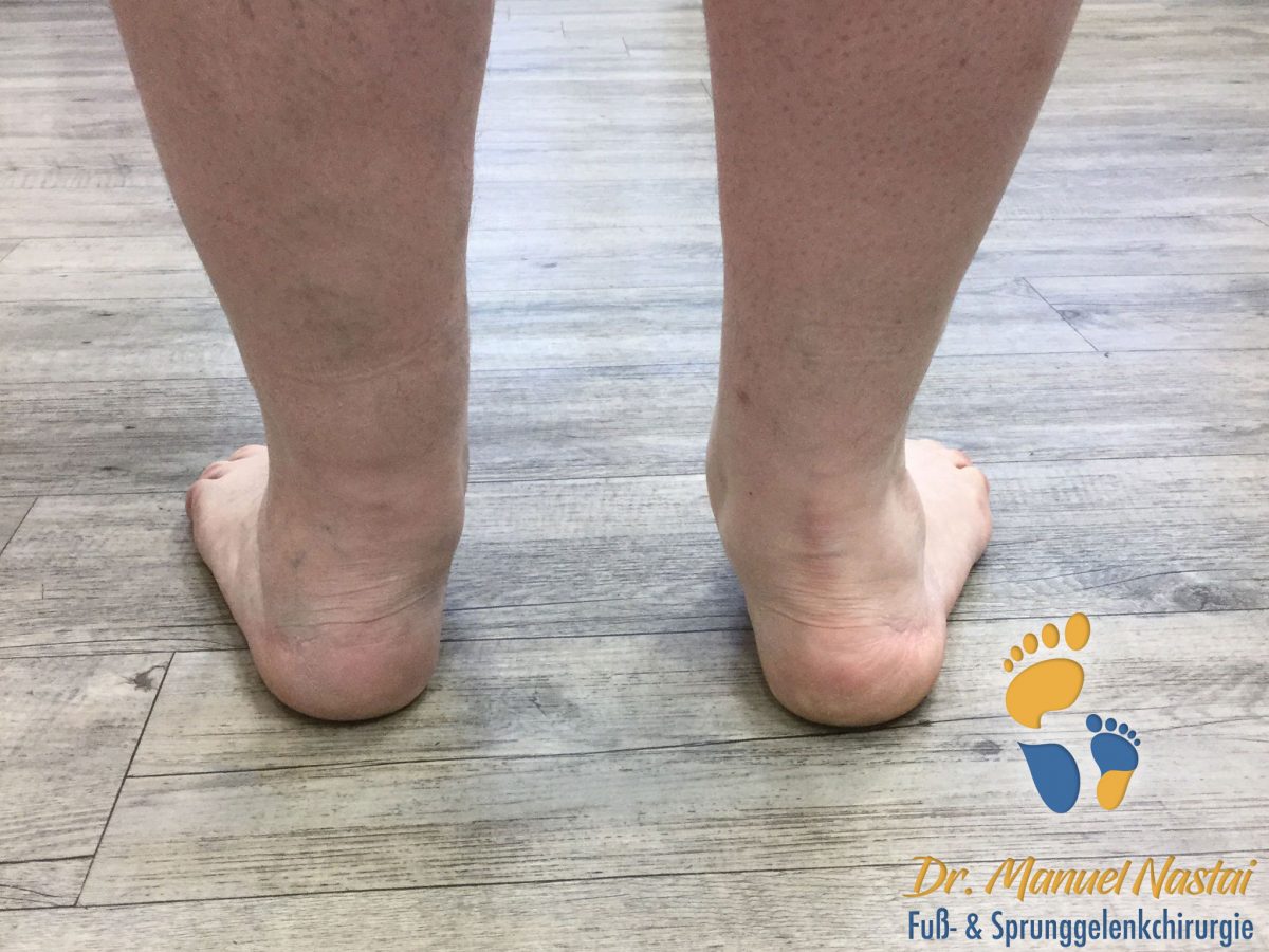 Triple tarsale Arthrodese bei Plattfuß Dr.medic Manuel Nastai