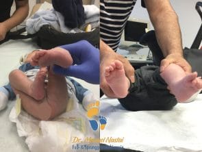 Ergebnis nach Klumpfußbehandlung durch Ponseti-Methode