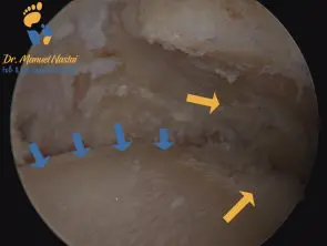 OSg Arthroskopie bei Arthrose mit Knorpelglatze