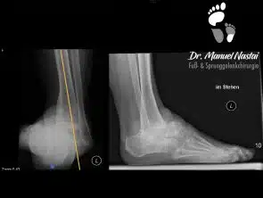 Erhebliche Varus-Sprunggelenksarthrose bei Hohlfuß