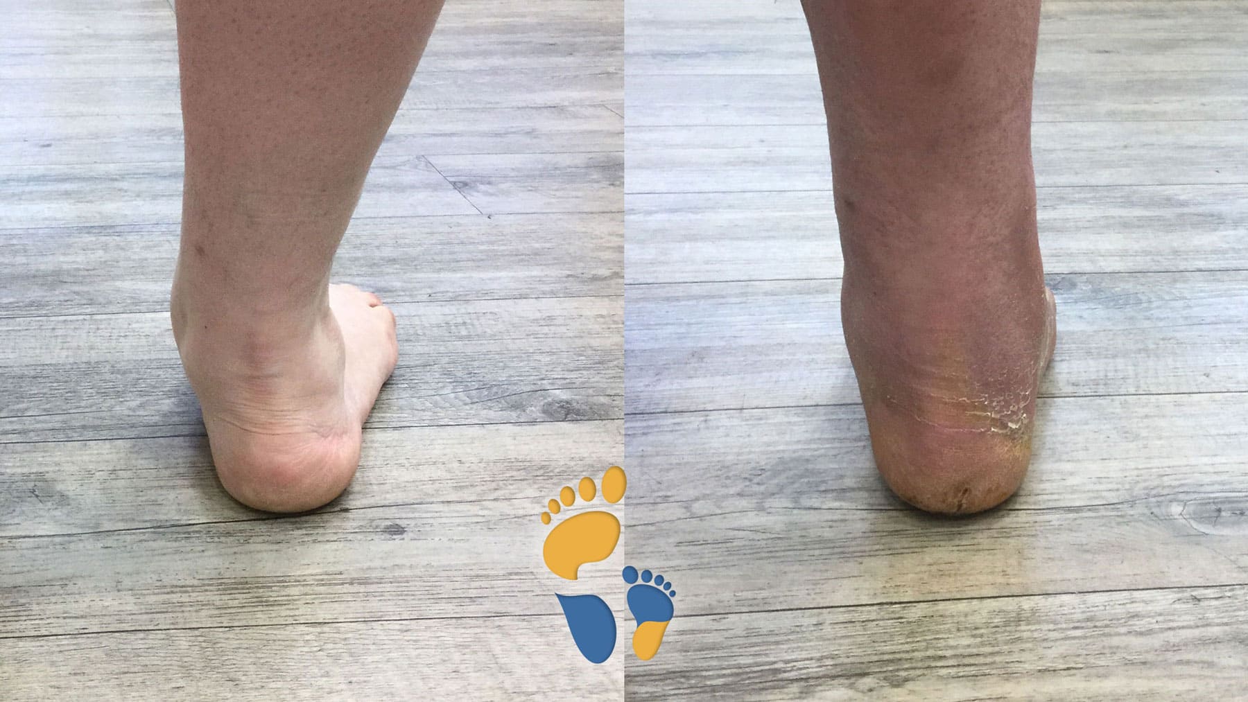 tripel tarsale Arthrodese bei Pes planovalgus