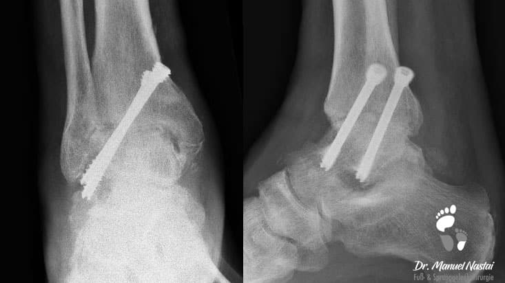 Arthroskopische OSG Versteifung