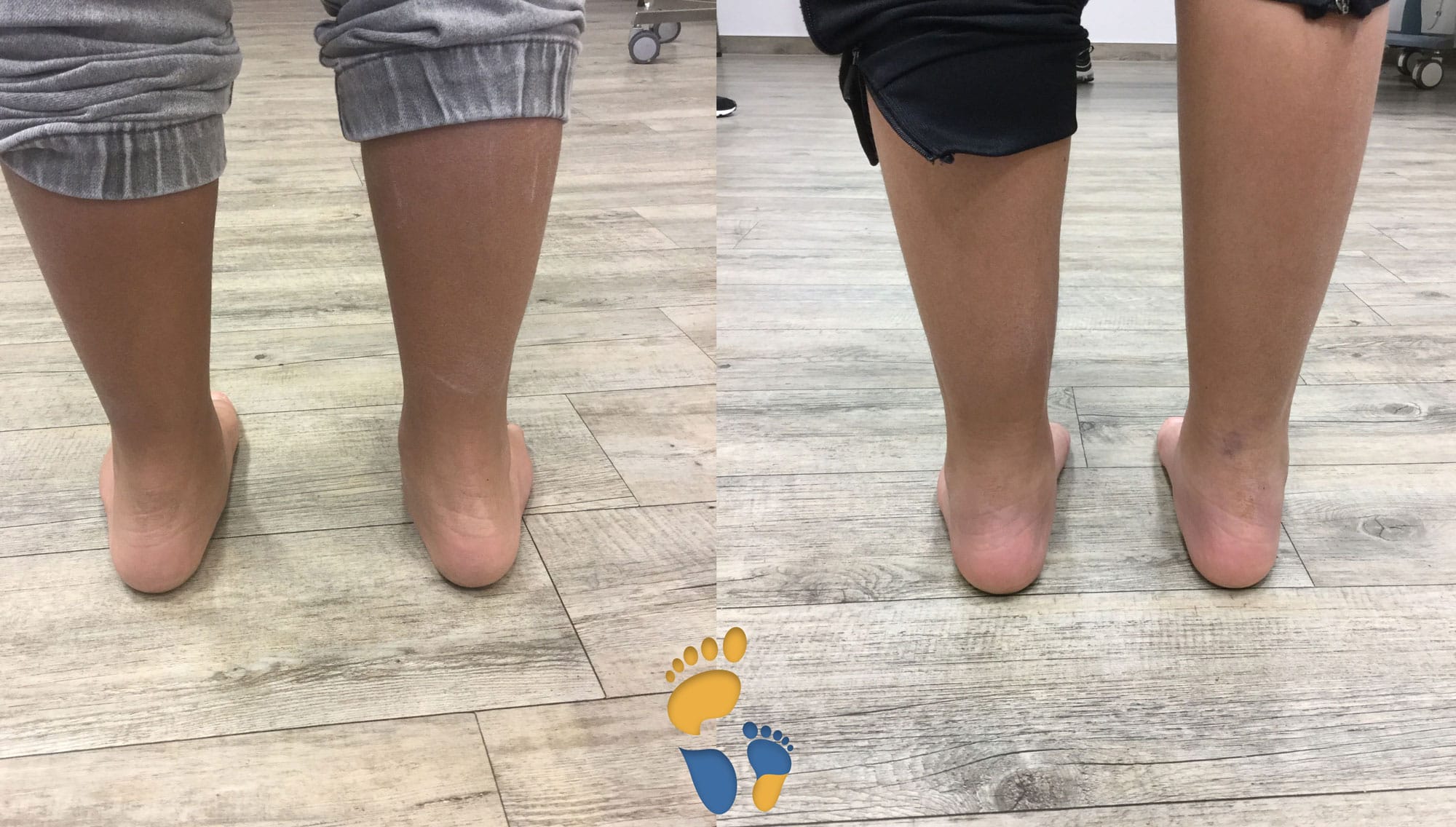 Arthrorise mit Talus-stopp Schraube