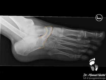 Plattfuss Pes Planovalgus Was Ist Und Was Kann Man Dagegen Tun