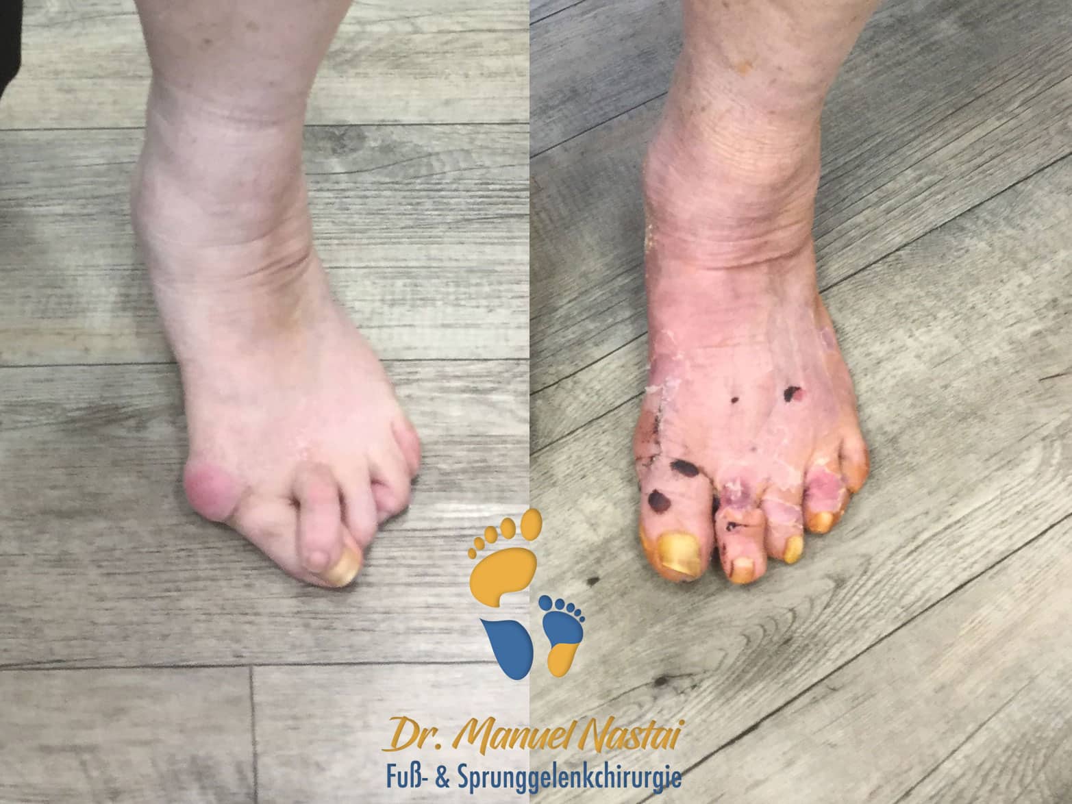 Korrektur einer komplexen Vorfußdeformität