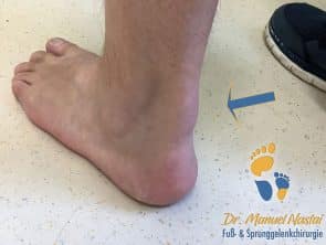 Schwellung der Achillessehne bei Achillodynie