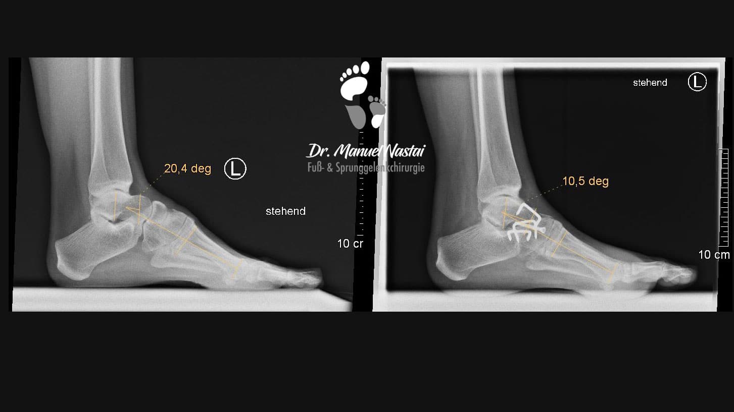 Hohlfußkorrektur durch Chopart-Arthrodese