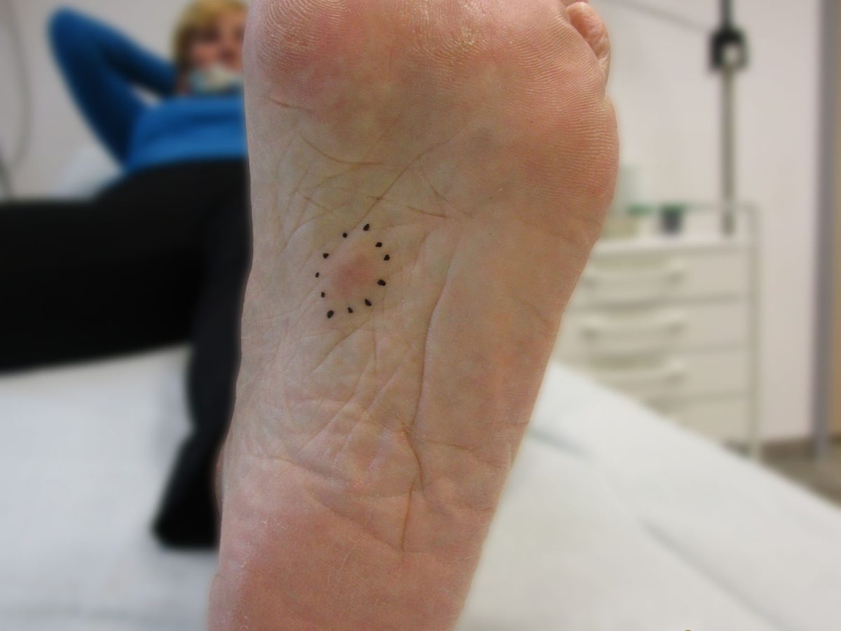 Morbus Ledderhose, die Krankheit mit Knoten an der Fußsohle