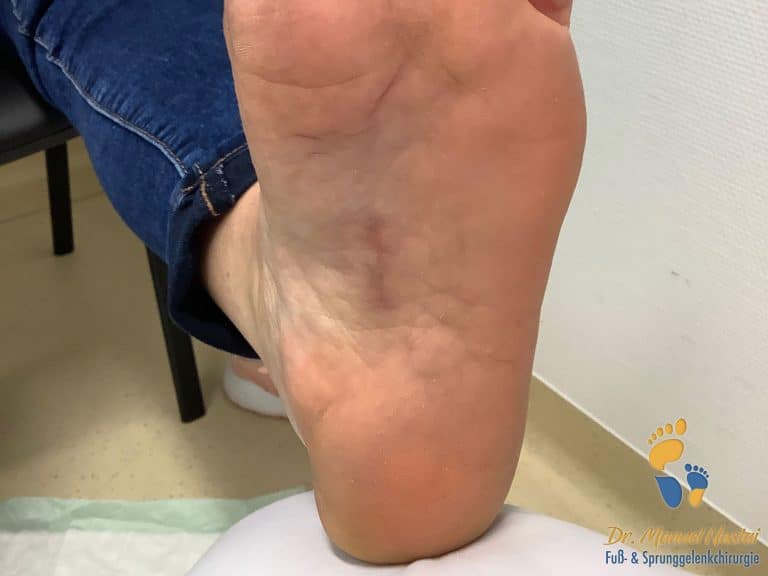 Morbus Ledderhose, die Krankheit mit Knoten an der Fußsohle
