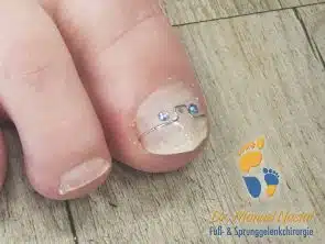 Nagelspange