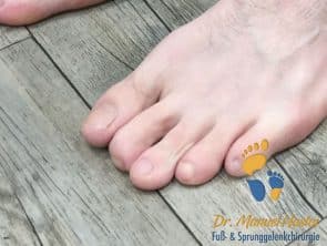 Mallet toe