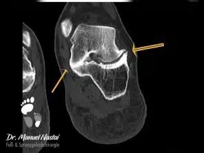 CT Coalitio talocalcaneare