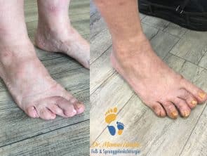 ergebnis nach minimalinvasiver Curly toe-Korrektur