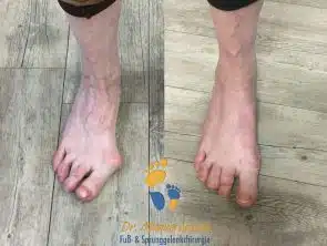 Hallux valgus-Korrektur durch Lapidus-Arthrodese