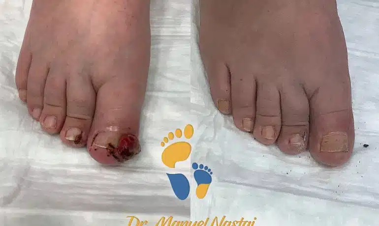 ergebnis nach Emmert-Plastik