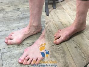 Ergebnis nach Lapidus-Arthrodese