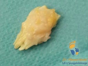 Morbus Ledderhose, die Krankheit mit Knoten an der Fußsohle