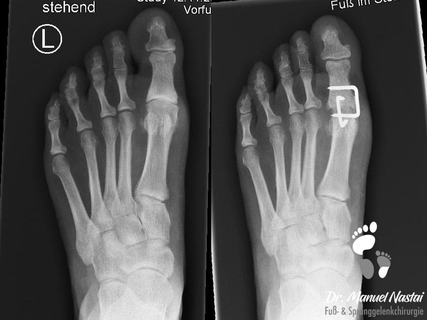 Hallux rigidus Op Versteifung des Großzehengrundgelenks