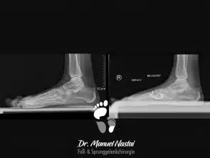 Seitliche Röntgen-Aufnahme nach Lapidus-Arthrodese